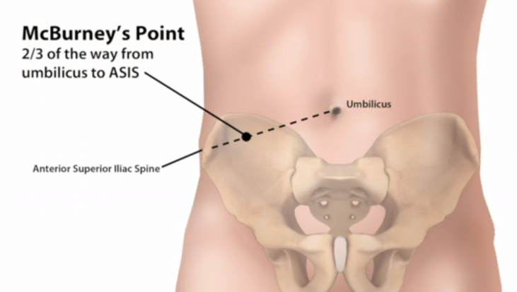 Appendicitis, sakit perut yang membawa maut!! - Root of Science