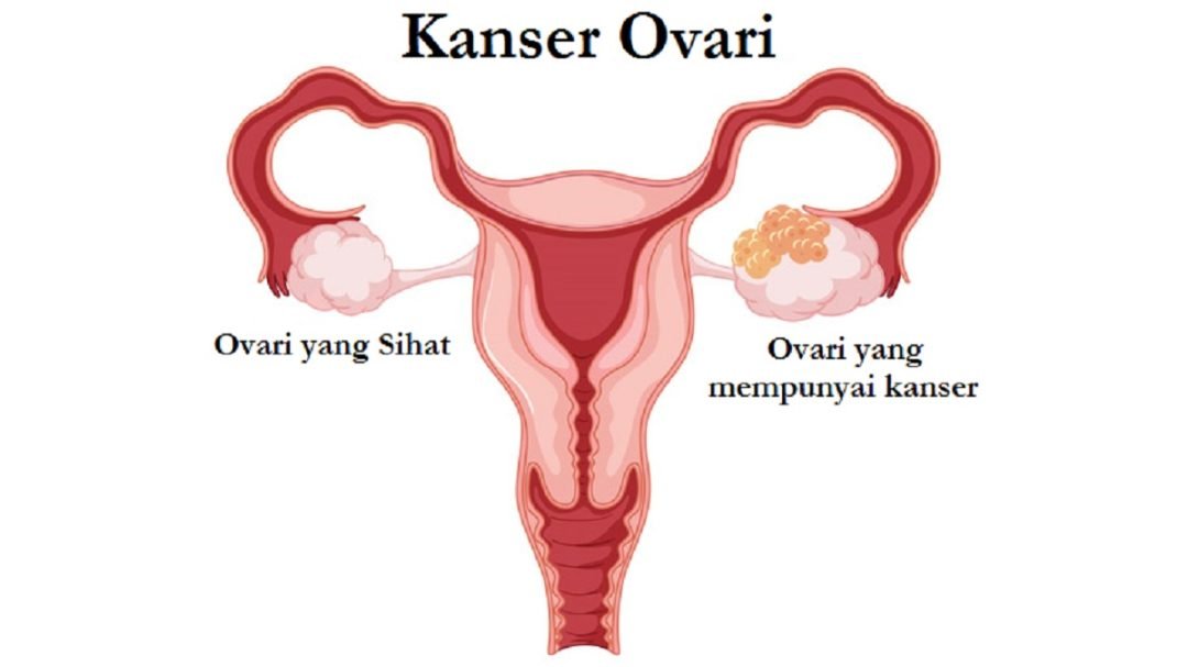 Kanser Ovari Punca Simptom And Rawatan Root Of Science